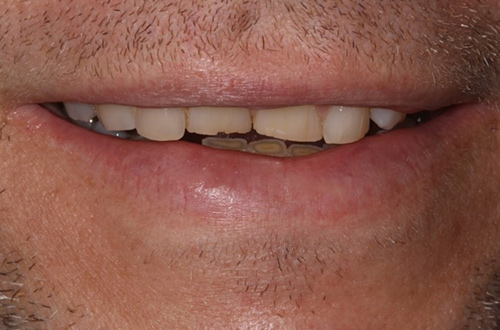 Before image shows worn down front teeth; an uneven smile prior to treatment at Bupa Dental Care Colchester Ipswich Road