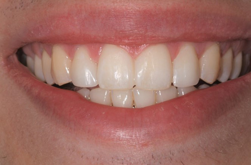 After images shows a straighter smile with no gaps following composite bonding at Bupa Dental Care Colchester Ipswich Road