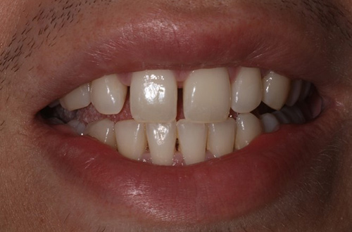 Before image shows a smile with gaps between teeth prior to treatment at Bupa Dental Care Colchester Ipswich Road