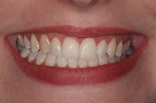 After image shows a less crowded, straighter smile following Invisalign treatment at Bupa Dental Care Colchester Ipswich Road