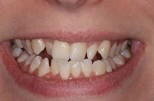 Before image show a crowded and crooked smile prior to treatment at Bupa Dental Care Colchester Ipswich Road
