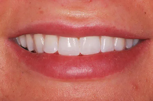 After image shows a whiter smile with no gaps after composite bonding and teeth whitening at Bupa Dental Care Congleton