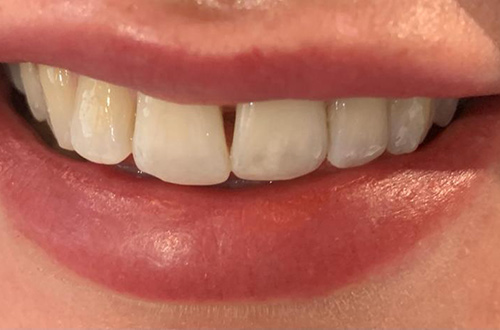 Before image shows a dull smile with gaps before treatment at Bupa Dental Care Congleton.