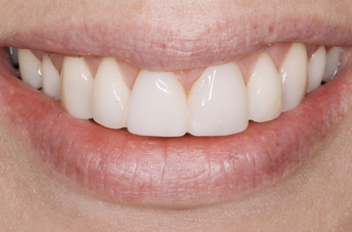 After image shows a brighter, fuller smile after composite bonding treatment at Bupa Dental Care Congleton