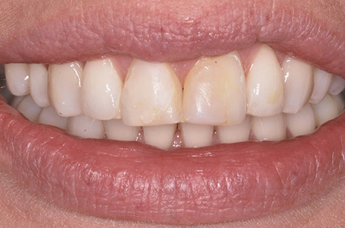 Before image shows stained composite fillings before treatment at Bupa Dental Care Congleton