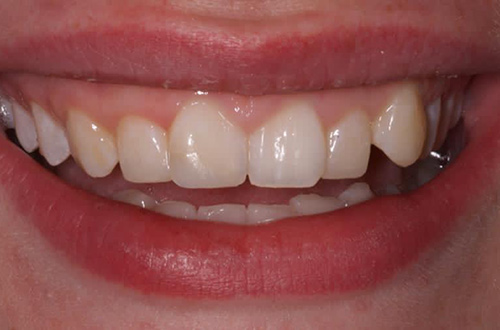 After image shows a fixed and fuller smile after composite bonding at Bupa Dental Care Congleton