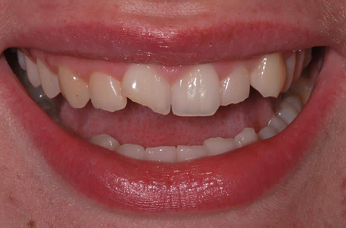 Before image shows chipped, broken teeth before composite bonding at Bupa Dental Care Congleton