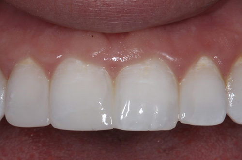 After image shows a straighter and fuller smile after composite bonding at Bupa Dental Care Congleton