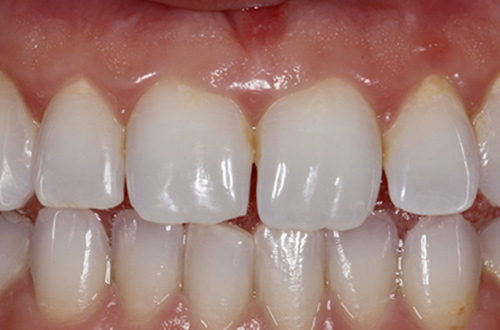 Before image shows chipped, broken teeth before composite bonding at Bupa Dental Care Congleton