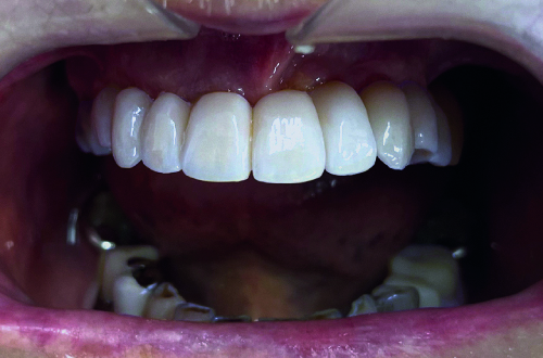 The patient’s straight and natural-looking upper teeth after receiving dental implants