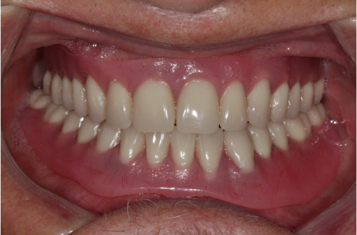 The patient’s mouth close up showing a straight and full set of teeth