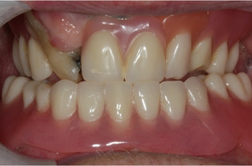 The patient’s left canine is twisted, and the root is visible