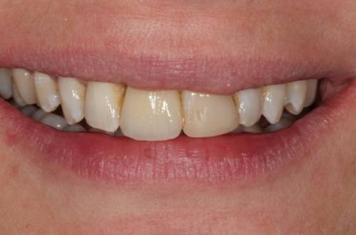 After treatment, the patient had a balanced smile with no visible gap thanks to the dental implant