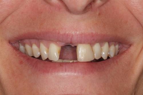 Before treatment, the patient's missing tooth left a big gap in their smile