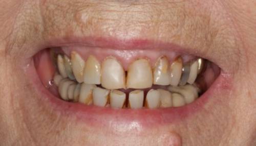 After treatment, the dental implant has filled the gap for a balanced and happy smile