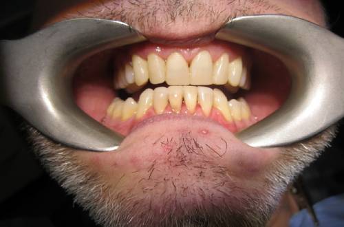 Sturdy molars with no visible caries and perfectly-aligned straight white teeth