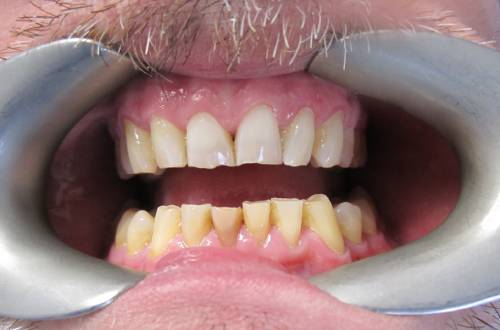 The lower arch incisors sit at different heights and look worn, with a lot of discolouration, especially on the edges of the teeth