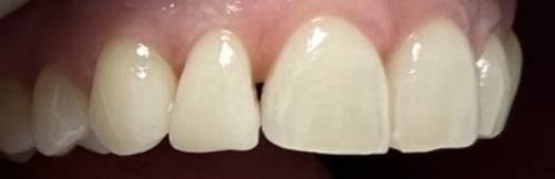  Bared teeth showing the top arch with an even bottom line on the right lateral incisor. The tooth edge is straighter and appears more complete. 