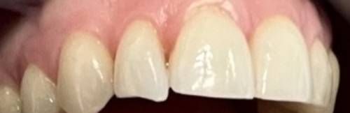  Bared teeth showing the top arch with an uneven bottom line on the right lateral incisor. The tooth appears a bit chipped. 