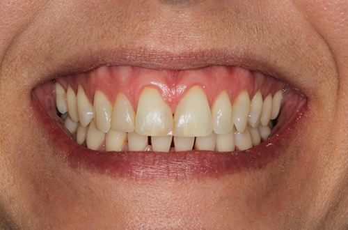 After image shows a fuller smile with no gaps after composite fillings at Bupa Dental Care Dereham