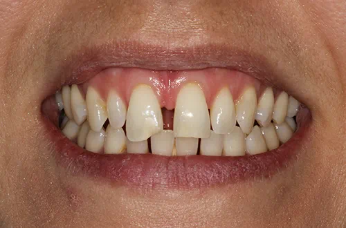 Before image shows a gap between the front teeth before treatment at Bupa Dental Care Dereham