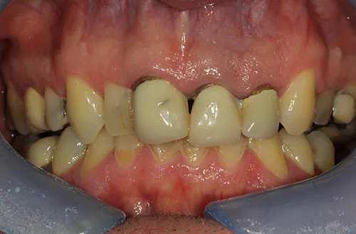 Before image shows wonky teeth before dental treatment at Bupa Dental Care Dereham