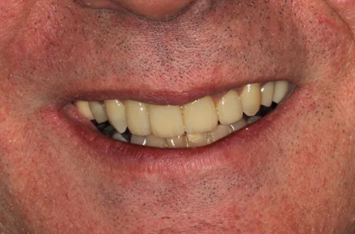 Patient Andrew showing off his new smile after treatment at Bupa Dental Care Dereham