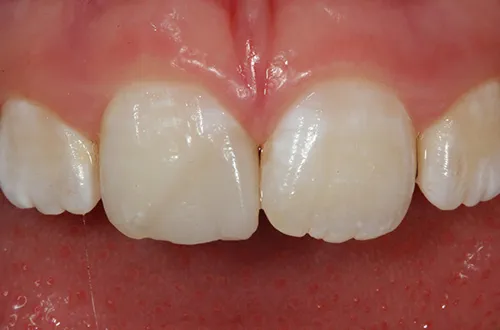 After image shows a fixed front tooth after composite filling at Bupa Dental Care Dereham