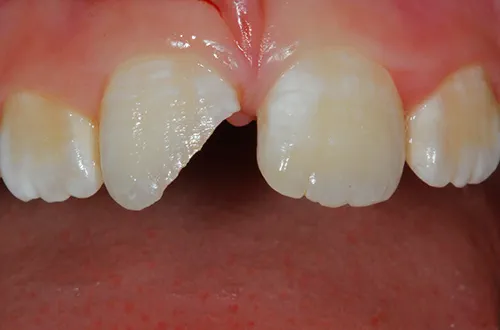 Before image shows chipped, broken front tooth before composite filling at Bupa Dental Care Dereham