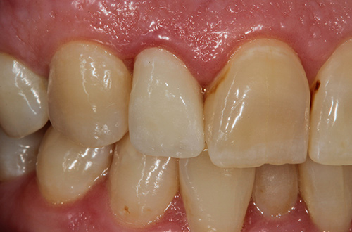 After image shows a fixed and fuller smile after root canal and dental crown treatment at Bupa Dental Care Dereham