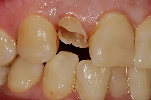 Before image shows broken front tooth before root canal treatment and a crown at Bupa Dental Care Dereham