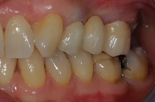 After image shows a fixed smile after treatment to fit a porcelain bonded bridge at Bupa Dental Care Dereham