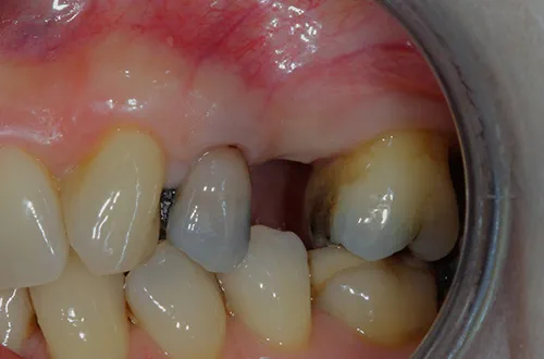 Before image shows missing tooth before treatment at Bupa Dental Care Dereham