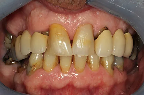 Before image shows missing teeth and a discoloured smile with gaps before restorative treatment at Bupa Dental Care Dereham