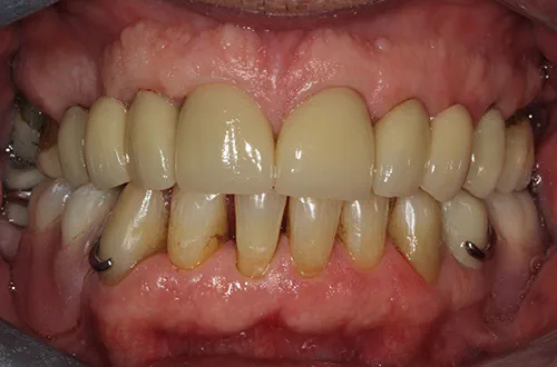After image shows a fuller smile after restorative treatment at Bupa Dental Care Dereham