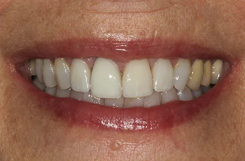 After image shows a brighter and fuller smile after cosmetic treatment, including veneers, at Bupa Dental Care Dereham 