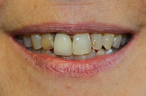 Before image shows a stained smile before cosmetic treatment at Bupa Dental Care Dereham