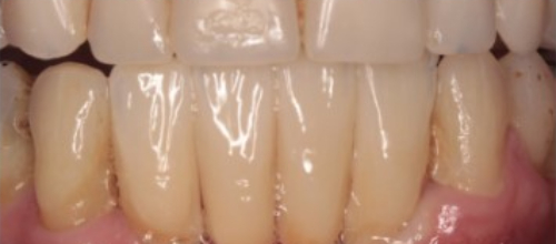 A close-up view of Catherine’s teeth post dental implant treatment