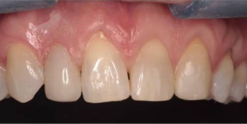 Heather after at-home whitening treatment, the removal of a veneer and composite bonding