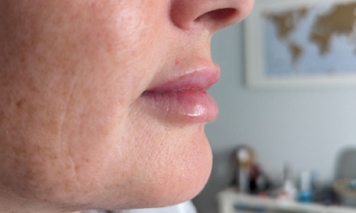 A side view of Karen after receiving lip filler