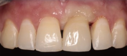 A close-up view of the patient’s top teeth post dental implant treatment
