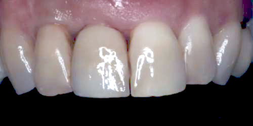 Melissa after receiving dental implant placement treatment and an implant crown