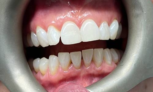 Retractors open the lips, showing white teeth with smooth edges 