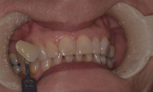  Retractors open the lips, showing teeth with a yellow appearance and slight chips on the enamel along the edge of the upper right central incisor 