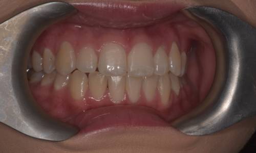 Retractors open the lips, showing rows of aligned teeth 