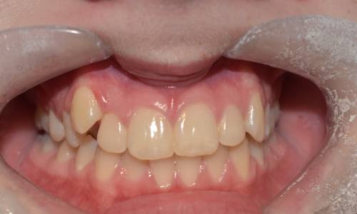 Open mouth showing teeth at different height in the top gums, especially apparent on the canines    