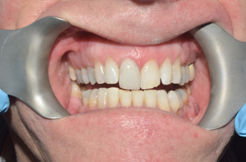 Bared teeth with no visible brown roots and a much cleaner and whiter appearance