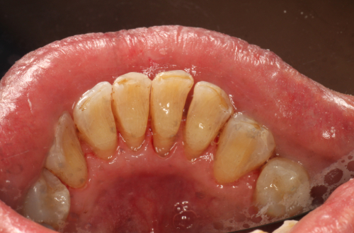 Open mouth showing lower arch of teeth where the backs of the teeth are tooth coloured and residue free