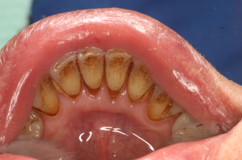 Open mouth showing lower arch of teeth, where the back of the teeth have brown marks and staining