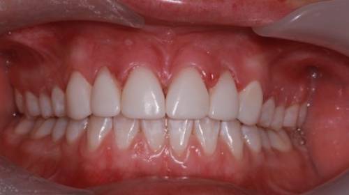 Composite bonding makes the front teeth look less gappy and brighter with no noticeable chip